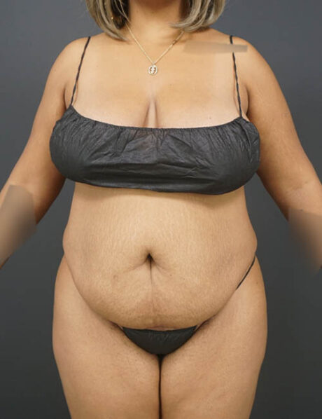 Tummy Tuck case #4799