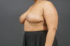 Breast Reduction case #4752