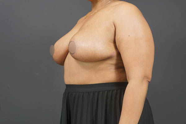 Breast Reduction case #4752