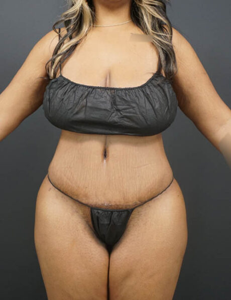 Tummy Tuck case #4799