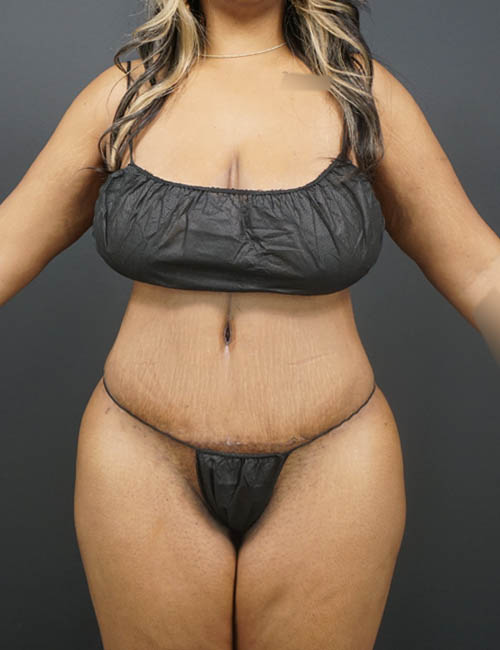 Tummy Tuck case #4799