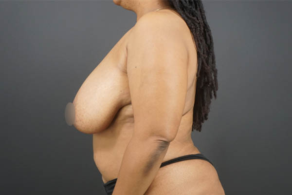 Breast Reduction case #4752