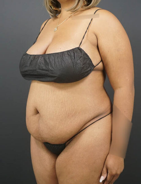 Tummy Tuck case #4799
