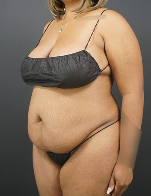 Tummy Tuck case #4799