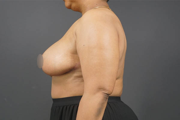 Breast Reduction case #4752