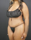 Tummy Tuck case #4799