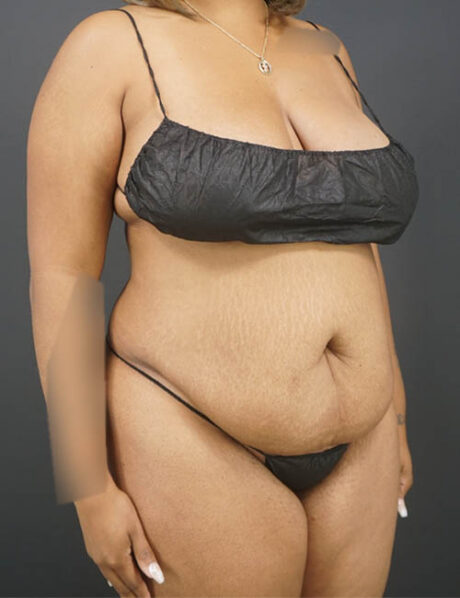 Tummy Tuck case #4799