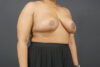Breast Reduction case #4752