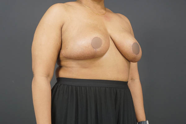 Breast Reduction case #4752