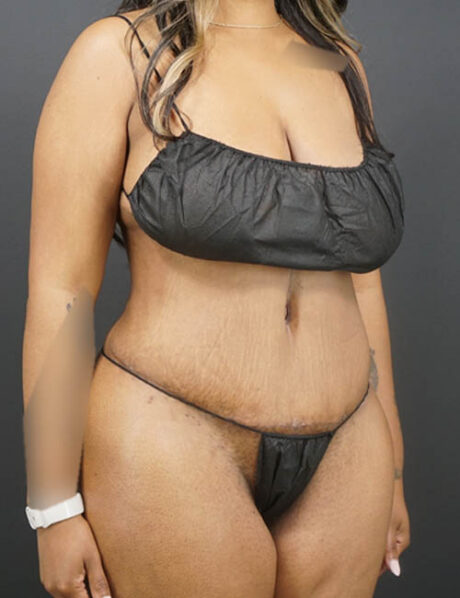 Tummy Tuck case #4799