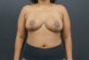 Breast Reduction case #4722