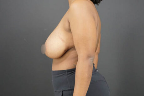 Breast Reduction case #4722