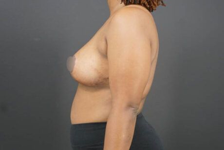 Breast Reduction case #4722