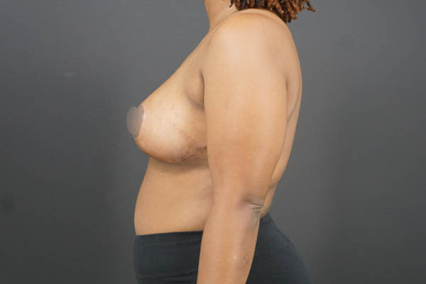 Breast Reduction case #4722