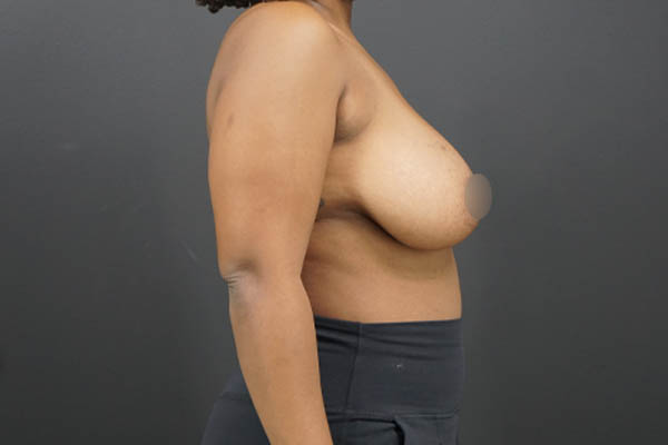 Breast Reduction case #4722