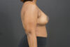 Breast Reduction case #4722