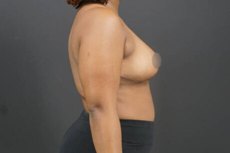 Breast Reduction case #4722
