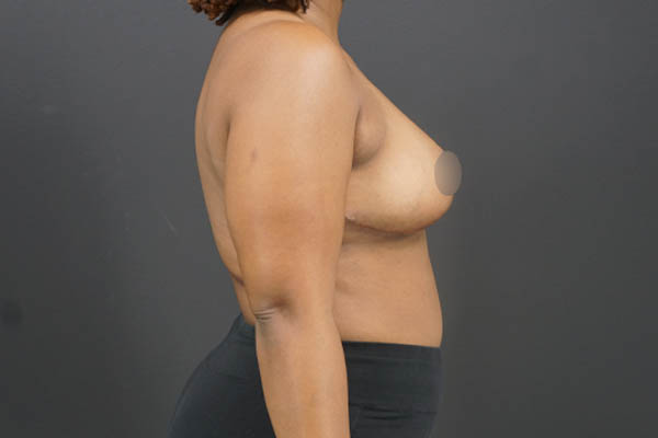 Breast Reduction case #4722