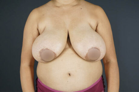 Breast Reduction case #4736