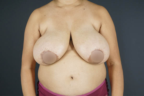 Breast Reduction case #4736