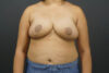Breast Reduction case #4736