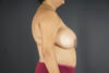 Breast Reduction case #4736