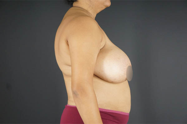 Breast Reduction case #4736