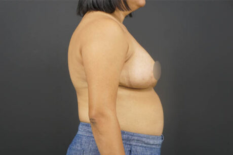 Breast Reduction case #4736