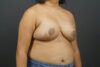 Breast Reduction case #4736