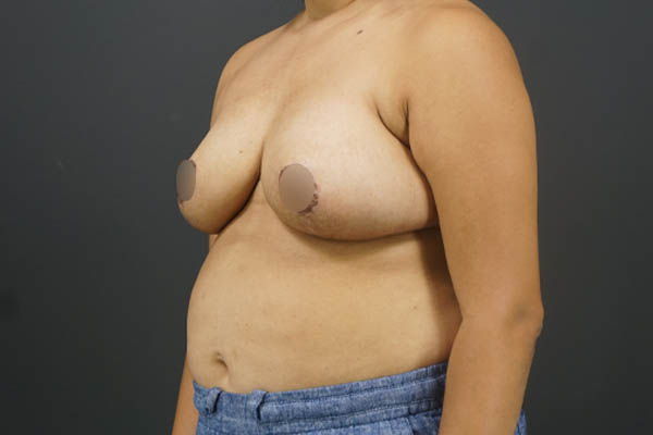 Breast Reduction case #4736