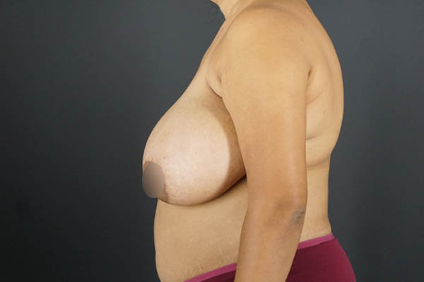 Breast Reduction case #4736