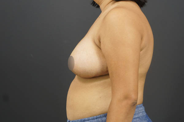 Breast Reduction case #4736