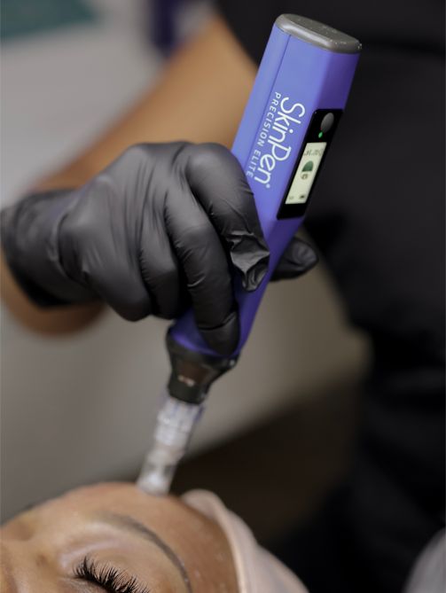 home-microneedling